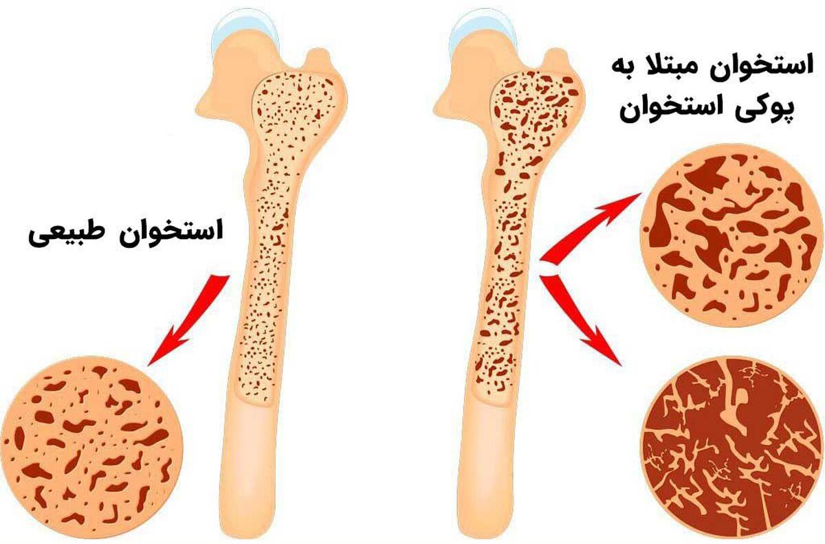پوکی استخوان؛بیماری خاموش،اما قابل پیشگیری