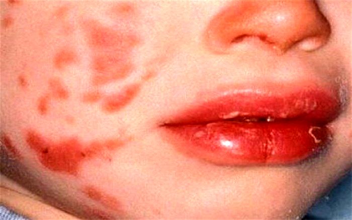 تب بالا، مهم‌ترین علامت بیماری کاوازاکی