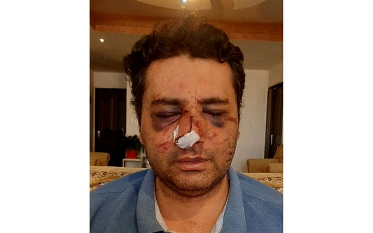 ضرب و شتم شدید یک متخصص بیهوشی توسط همراهان یک بیمار در پیرانشهر+عکس