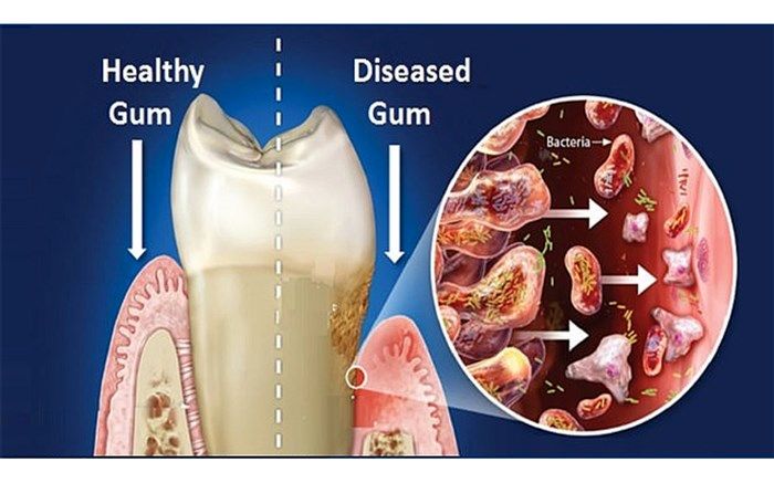 ارتباط مستقیم بیماری لثه و مرگبار شدن ویروس کرونا