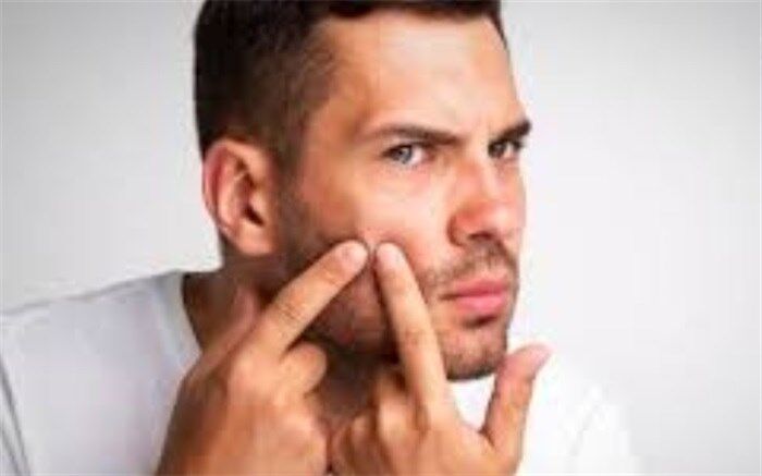 نسخه تغذیه‌ای برای کنترل جوش‌ها