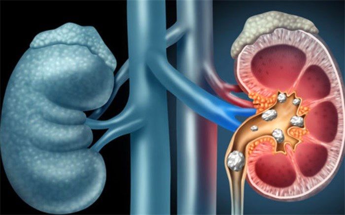 چند توصیه پزشکی درباره کلیه‌ها