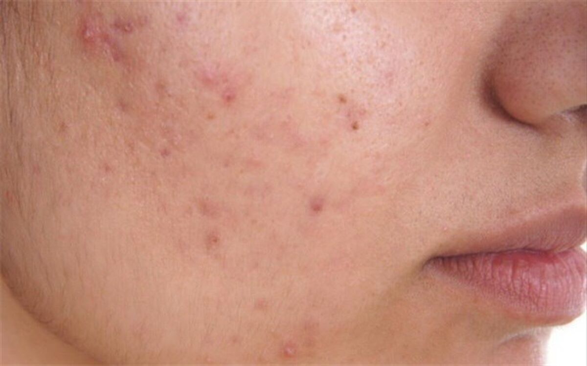7 علت آکنه روی قفسه سینه