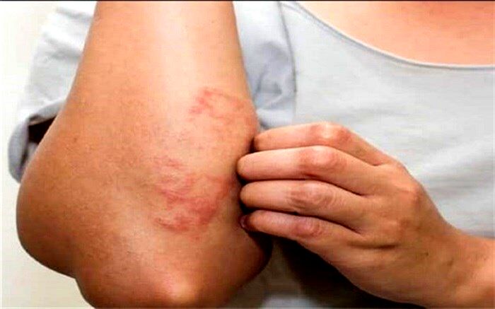 ۹ ماده غذایی  که باعث خارش می‌شود