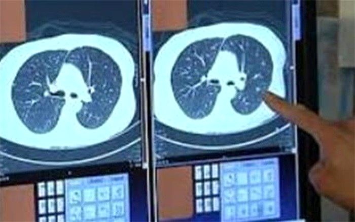 دلایل سوراخ شدن ریه بیماران کرونایی
