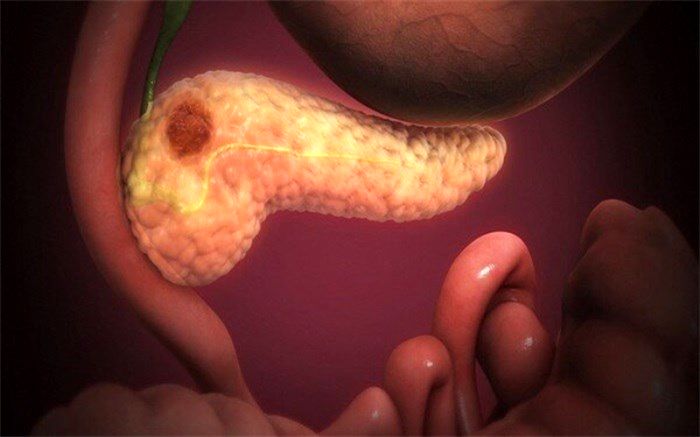 کشف یک مسیر مولکولی جدید برای مقابله با سرطان پانکراس