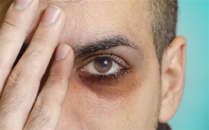 علت حلقه‌های تیره پای چشم