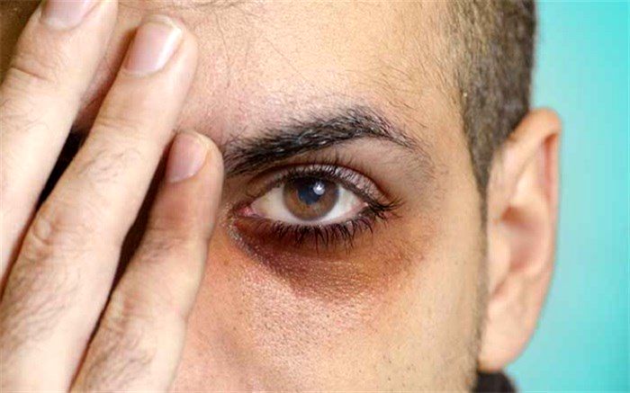علت حلقه‌های تیره پای چشم