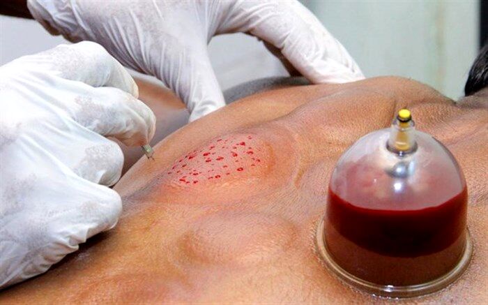 حجامت باعث تقویت سیستم ایمنی بدن می شود