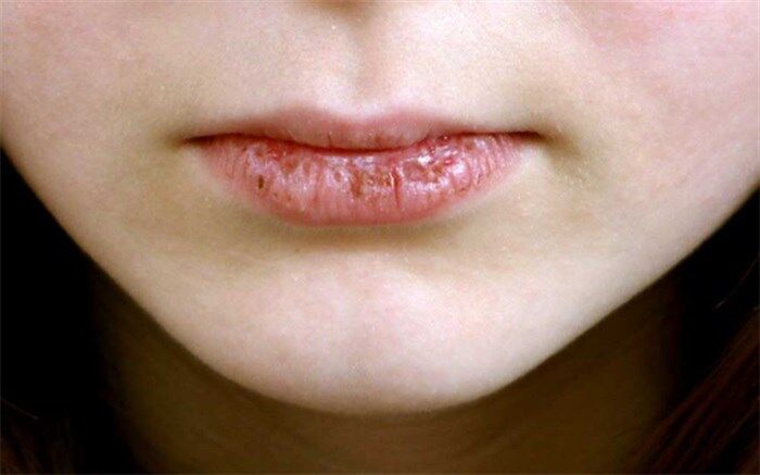 راه‌های بهبود خشکی دهان