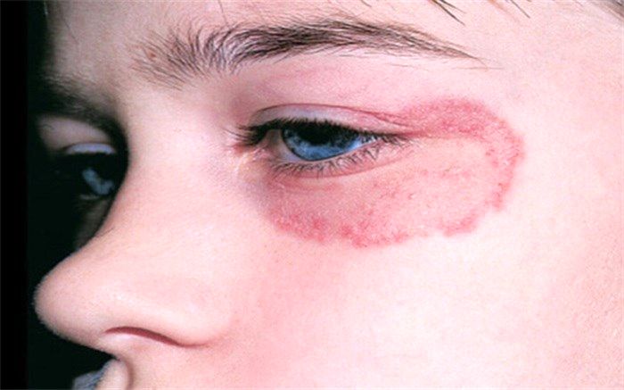 ویروسی که همراه کرونا جان می‌گیرد