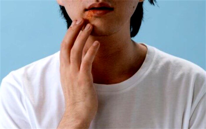 چند توصیه بهداشتی درباره تبخال
