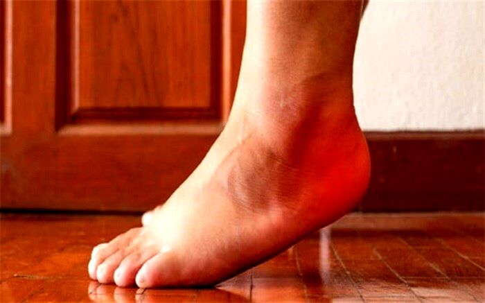 دلایل بروز درد در پاشنه پس از ورزش