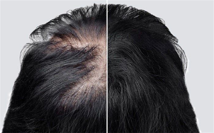 چرا بهبودیافتگان کرونا دچار ریزش مو می‌شوند