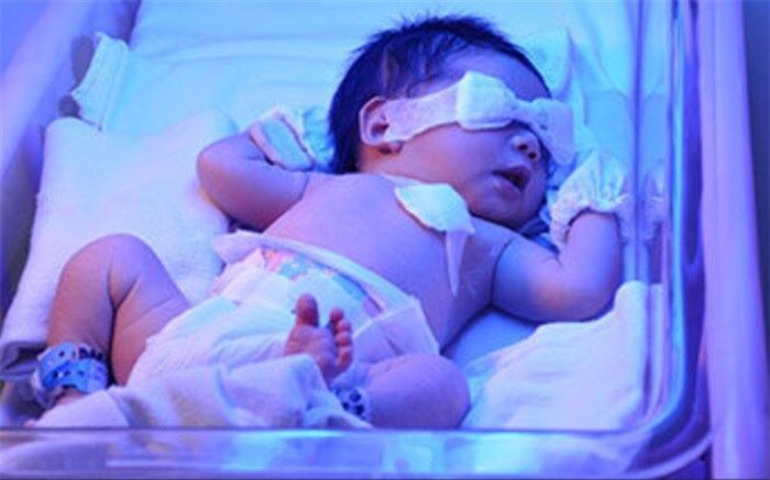 روشی برای کاهش زردی نوزادان