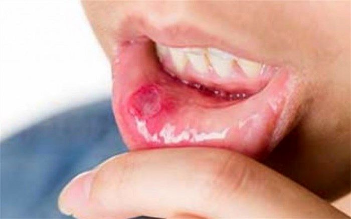 اختلال در بلع کودکان با مصرف داروهای شیمی درمانی