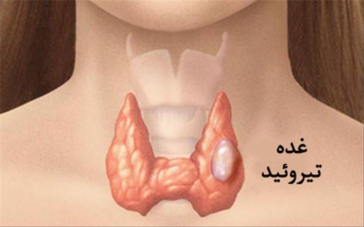 علائم سرطان تیروئید
