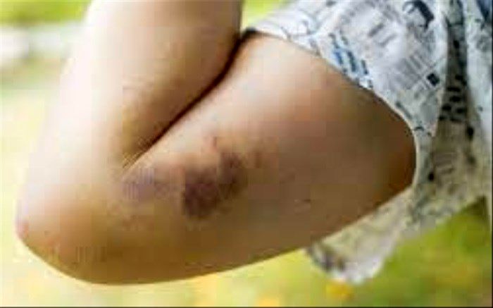 5  دلیل احتمالی کبودی در بدن