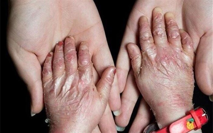 بیش از ۱۴ هزار قطعه پانسمان بیماران ‌ای بی‌ در انبار هیات امنای صرفه‌جویی ارزی موجود است