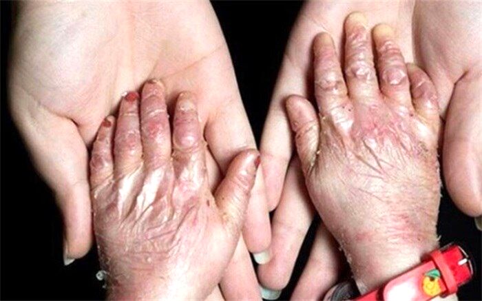 روند صعودی مشکلات مبتلایان به بیماری‌های نادر؛ کمیته بیماری‌های نادر در مجلس تشکیل شد