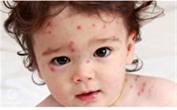 یک بیماری مرگبار پشت مرزهای ایران