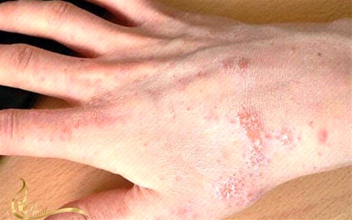 حساسیت به آب عجیب‌ترین آلرژی که زنان به آن مبتلا می‌شوند