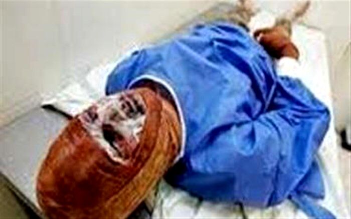 افزایش ۱۷ درصدی تلفات سوختگی در آذربایجان‌شرقی