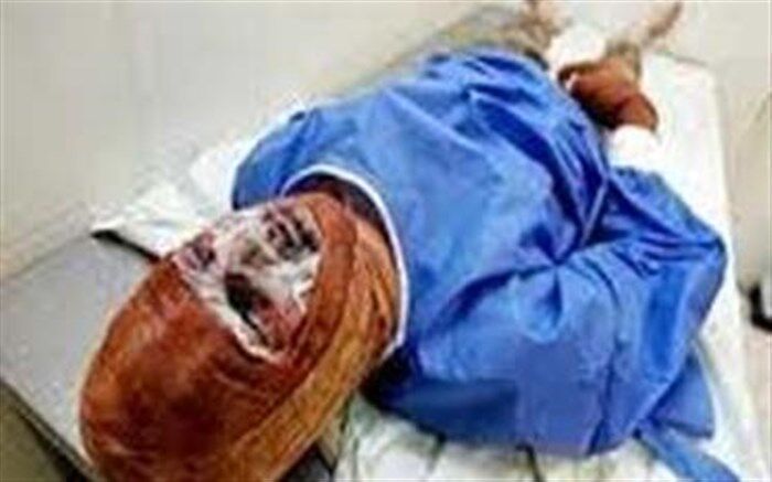 افزایش ۱۷ درصدی تلفات سوختگی در آذربایجان‌شرقی