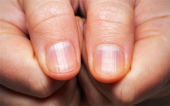 چرا ناخن‌ها تغییر شکل می‌دهند