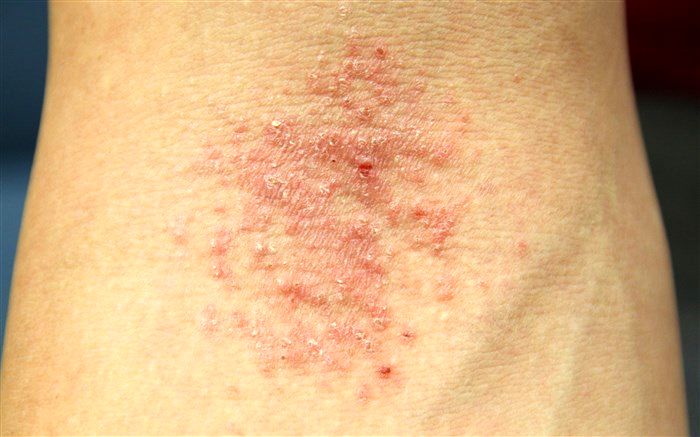 علائم اگزما را چگونه تسکین دهیم؟