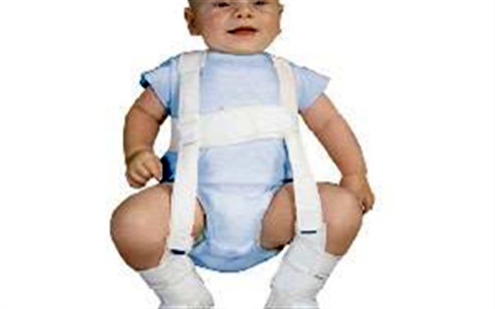 علائم در رفتگی مادرزادی لگن