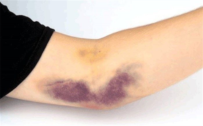 چگونه از شر کبودی‌ها خلاص شویم؟