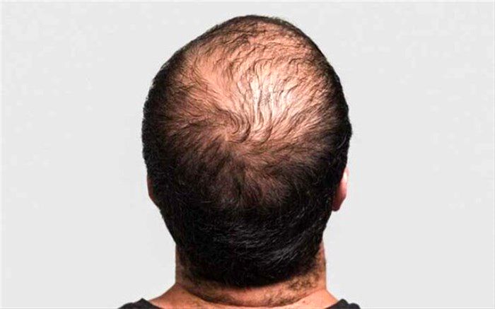 کدام غذاها به سلامت و رشد مو کمک می‌کنند؟