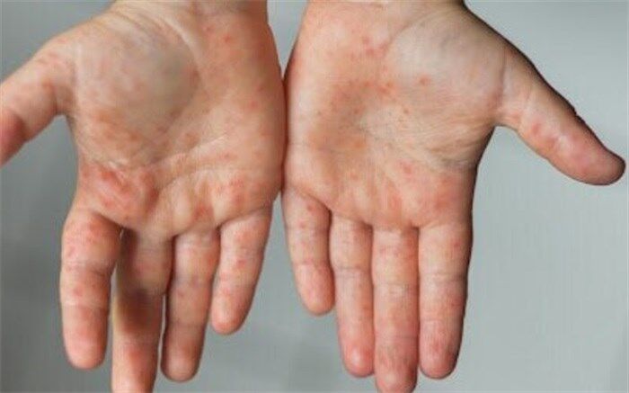 واکسیناسیون ۲۳۰ هزار اتباع غیرایرانی علیه سرخک تاکنون