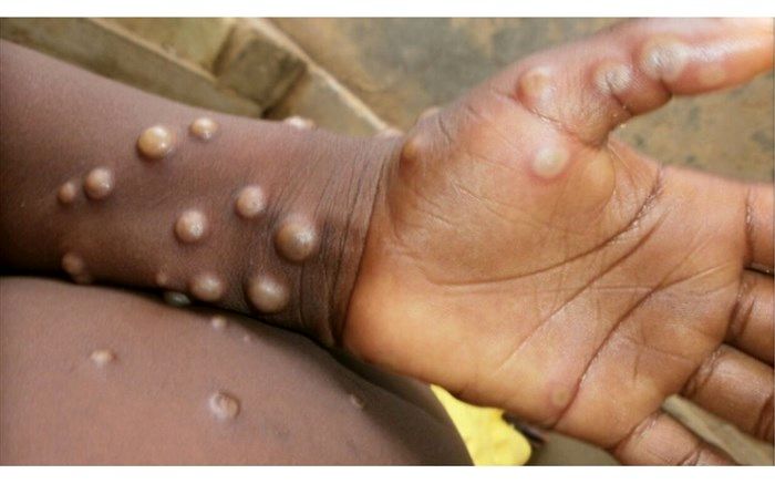 میزان مرگ و میر آبله میمون و کرونا قابل مقایسه نیست