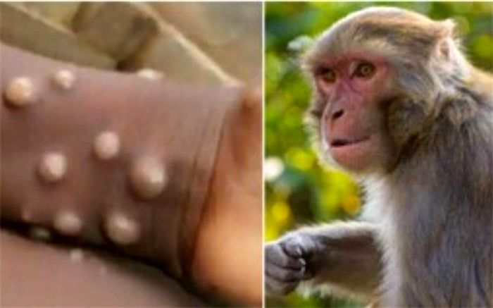 آبله میمونی قدرت انتقال بیشتری دارد یا کرونا؟