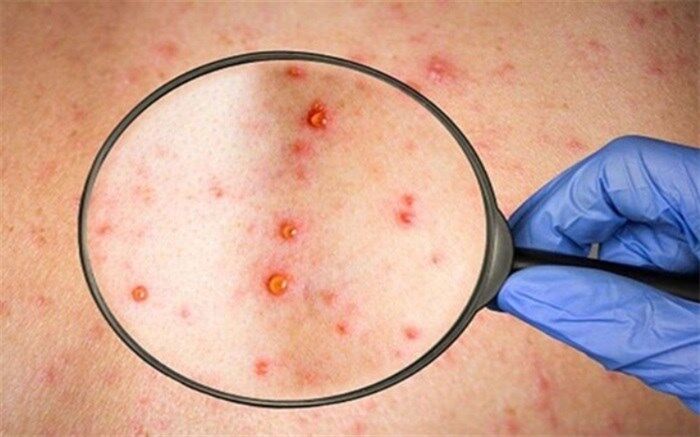 پاسخ به ۷ سوال مهم درباره آبله میمون