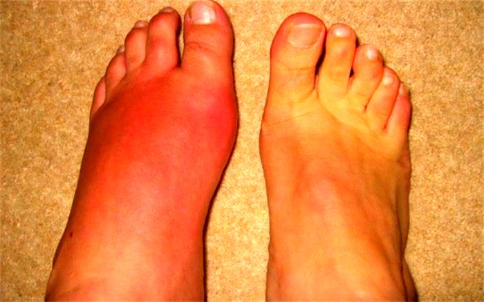 اگر نقرس دارید، این غذاها را نخورید