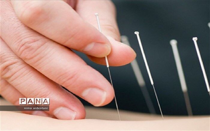 طب سوزنی راهکاری منحصر به فرد برای بیماری‌های مختلف
