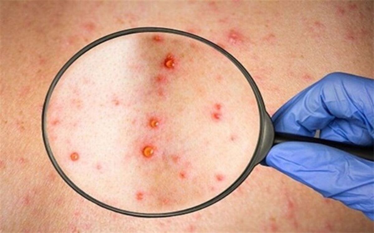 چه کسانی در معرض خطر ابتلا به آبله میمون هستند؟