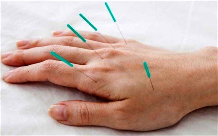طب سوزنی چه عوارضی دارد؟