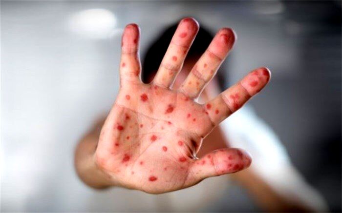 شیوع تب گوجه‌فرنگی؛ از این بیماری بیشتر بدانید