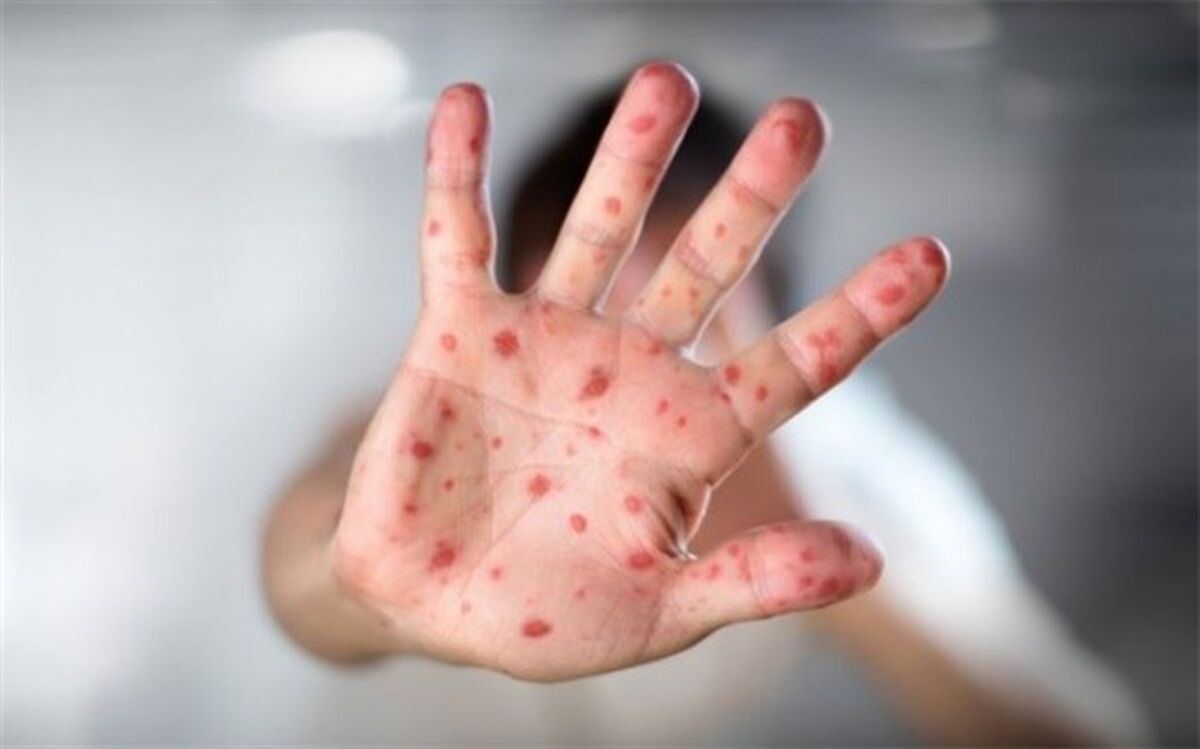 شیوع تب گوجه‌فرنگی؛ از این بیماری بیشتر بدانید