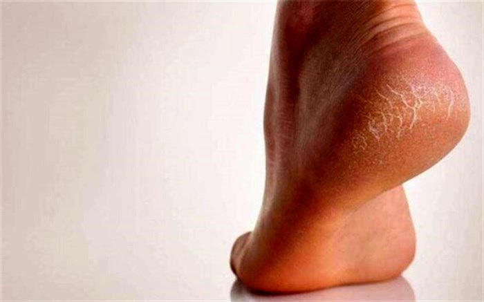 مورمور شدن پا نشانه چیست؟