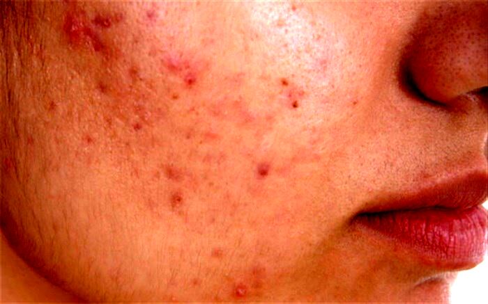 از روش‌های خانگی برای درمان آکنه چه می‌دانیم؟