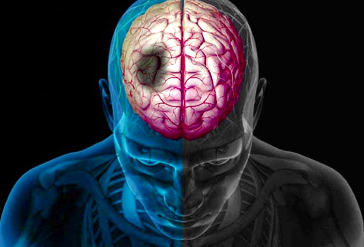 هر ۴۰ ثانیه، یک سکته مغزی در آمریکا رخ می‌دهد
