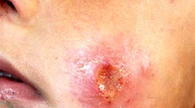 سالک بیماری پیچیده‌ای که نادیده گرفته شد