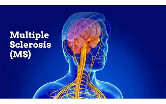 وزیر بهداشت: داروی ایرانی بیماری MS به بیش از ۴۰ کشور دنیا صادر می‌شود