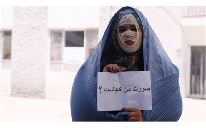 نظر ابتکار درباره طرح تشدید مجازات اسیدپاشی