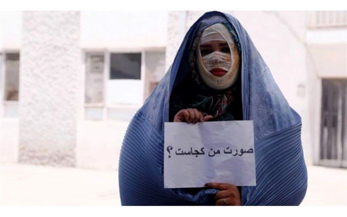 نظر ابتکار درباره طرح تشدید مجازات اسیدپاشی